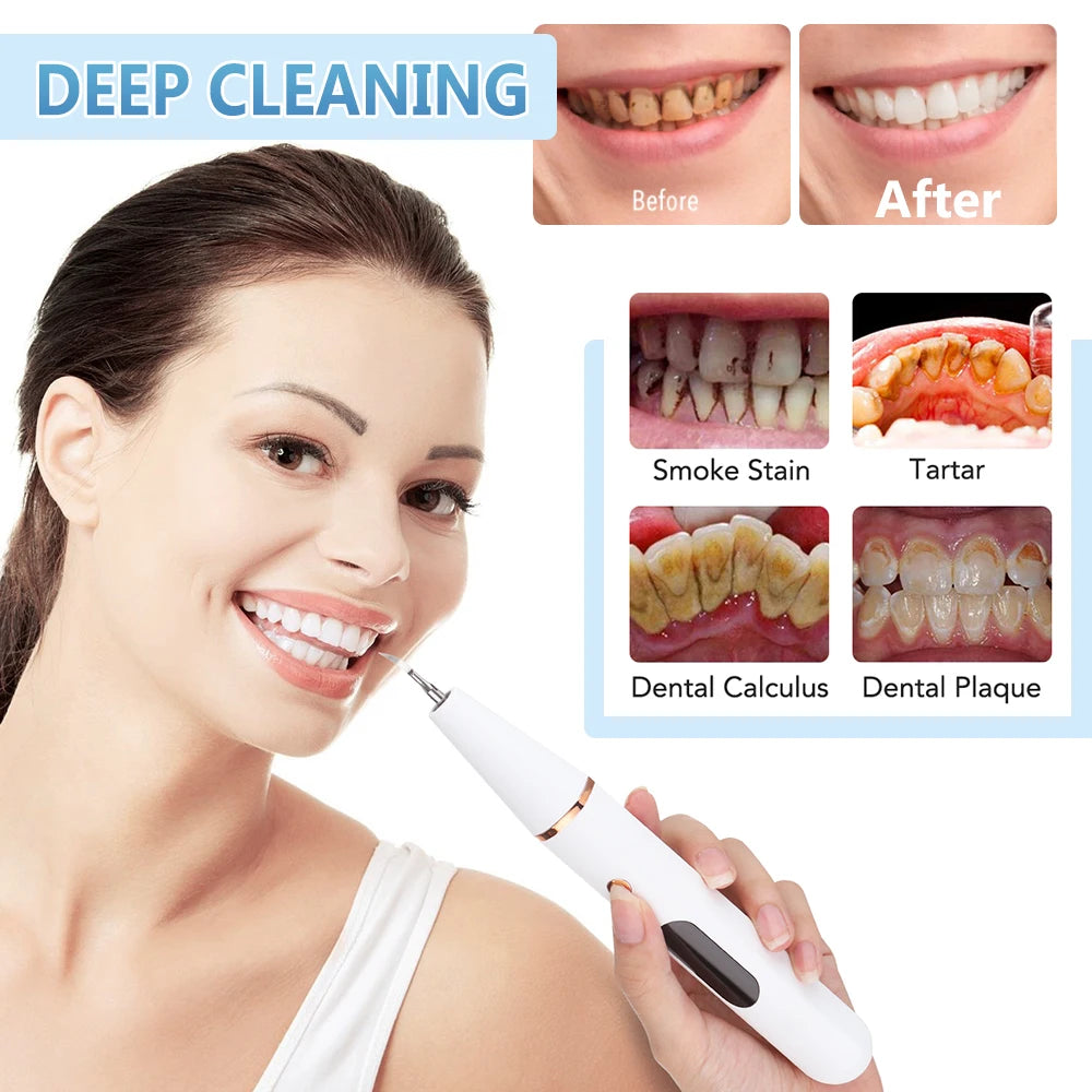 Détartreur dentaire à ultrasons, nettoyeur de dents