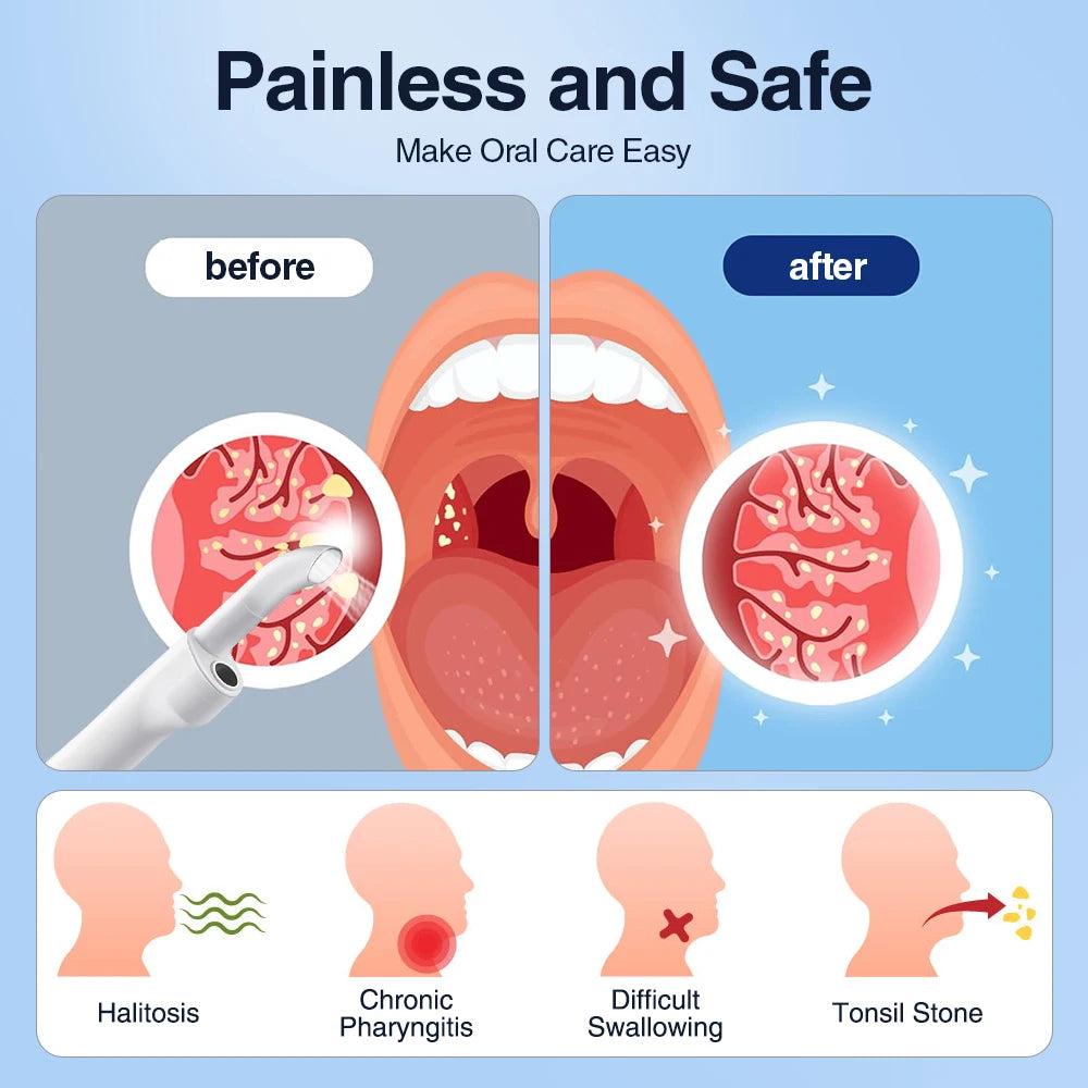 Dissolvant visuel électrique de pierre d'amygdale Kit d'élimination de pierre d'amygdale vide avec seringue d'irrigation aspiration instantanée pierre d'amygdale Remova
