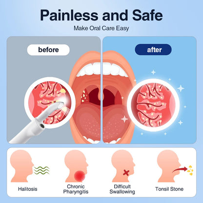 Dissolvant visuel électrique de pierre d'amygdale Kit d'élimination de pierre d'amygdale vide avec seringue d'irrigation aspiration instantanée pierre d'amygdale Remova
